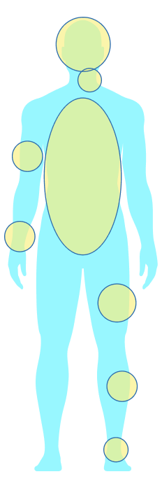 Here are common sites for Plexiform Neurofibromas.